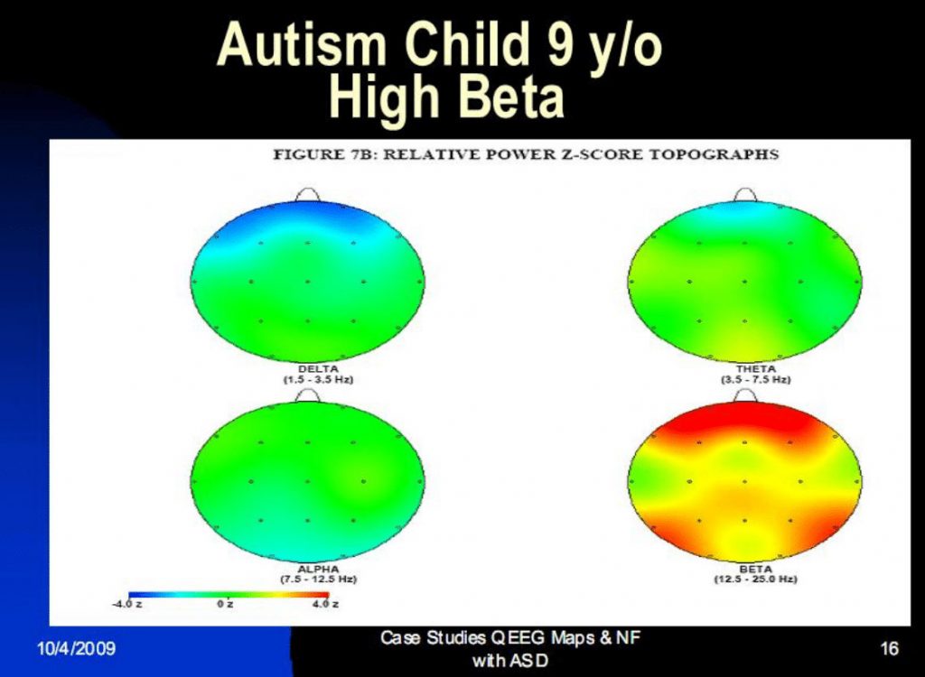 Brainmaps Kind 9 Jahre mit Autismus 