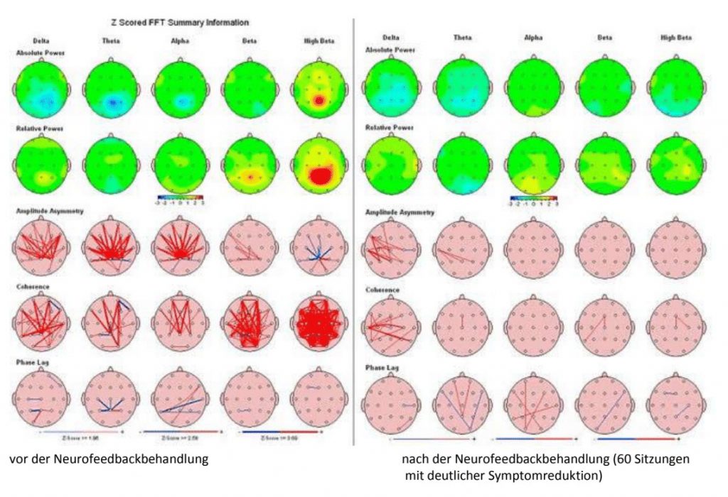 Brainmaps vor und nach der Neurofeedbackbehandlung